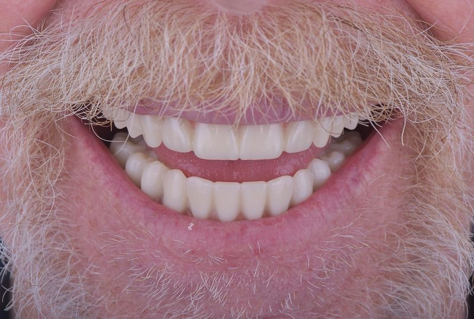 After All-on-4 dental implants in Nagoya — fully restored natural-looking smile at Eden Dental Office