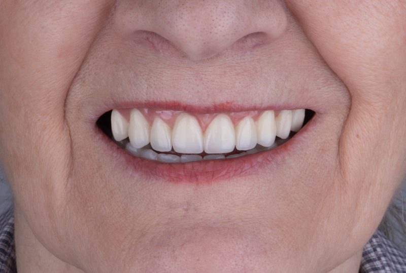 After full-mouth rehabilitation in Nagoya — complete implant-supported smile at Eden Dental Office
