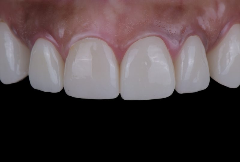 After single tooth implant in Nagoya — seamless Straumann implant restoration at Eden Dental Office
