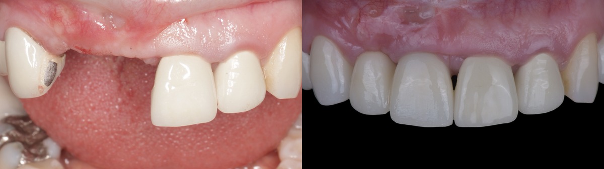 Aesthetic dentistry before and after — natural smile restoration in Nagoya