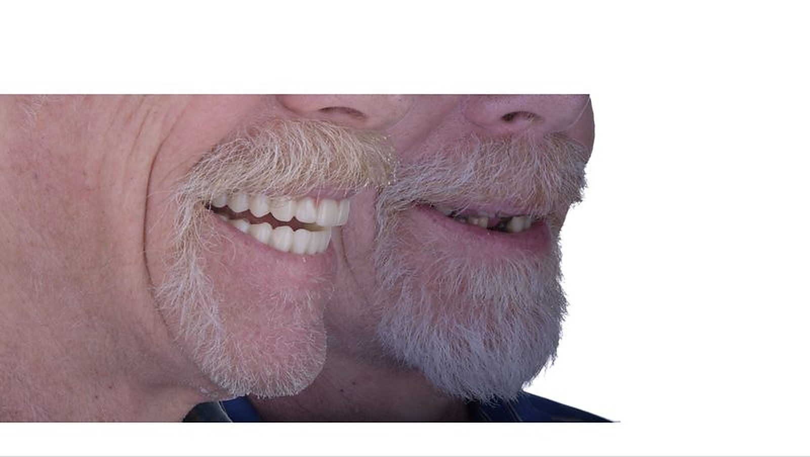 All-on-4 full-arch restoration — complete smile makeover at Eden Dental Office Nagoya