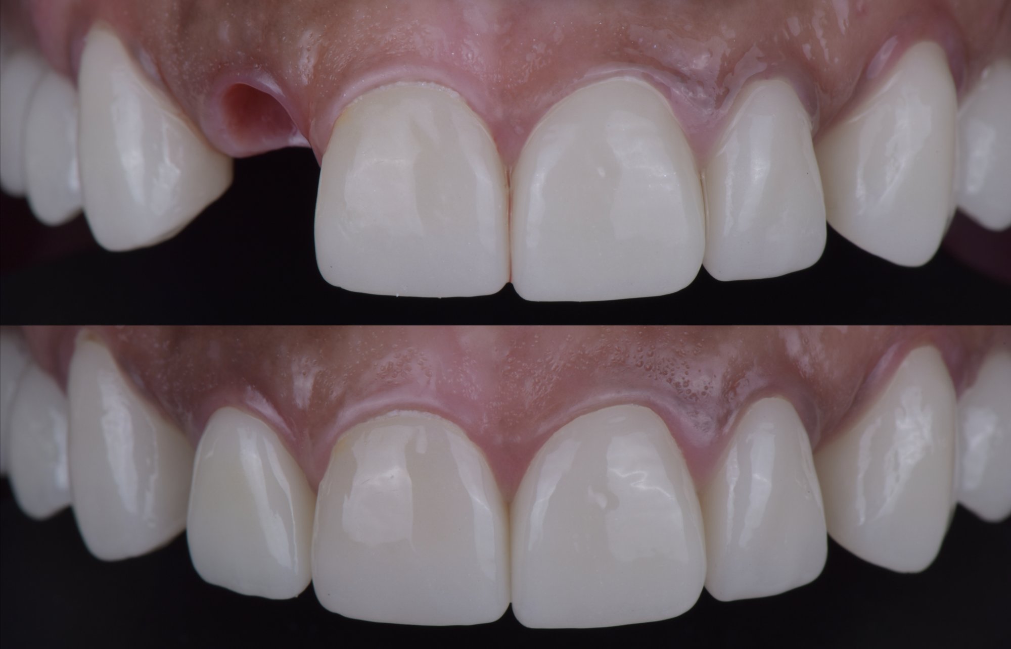 Before and after: front tooth implant with bone and gum grafting at Eden Dental Office Nagoya
