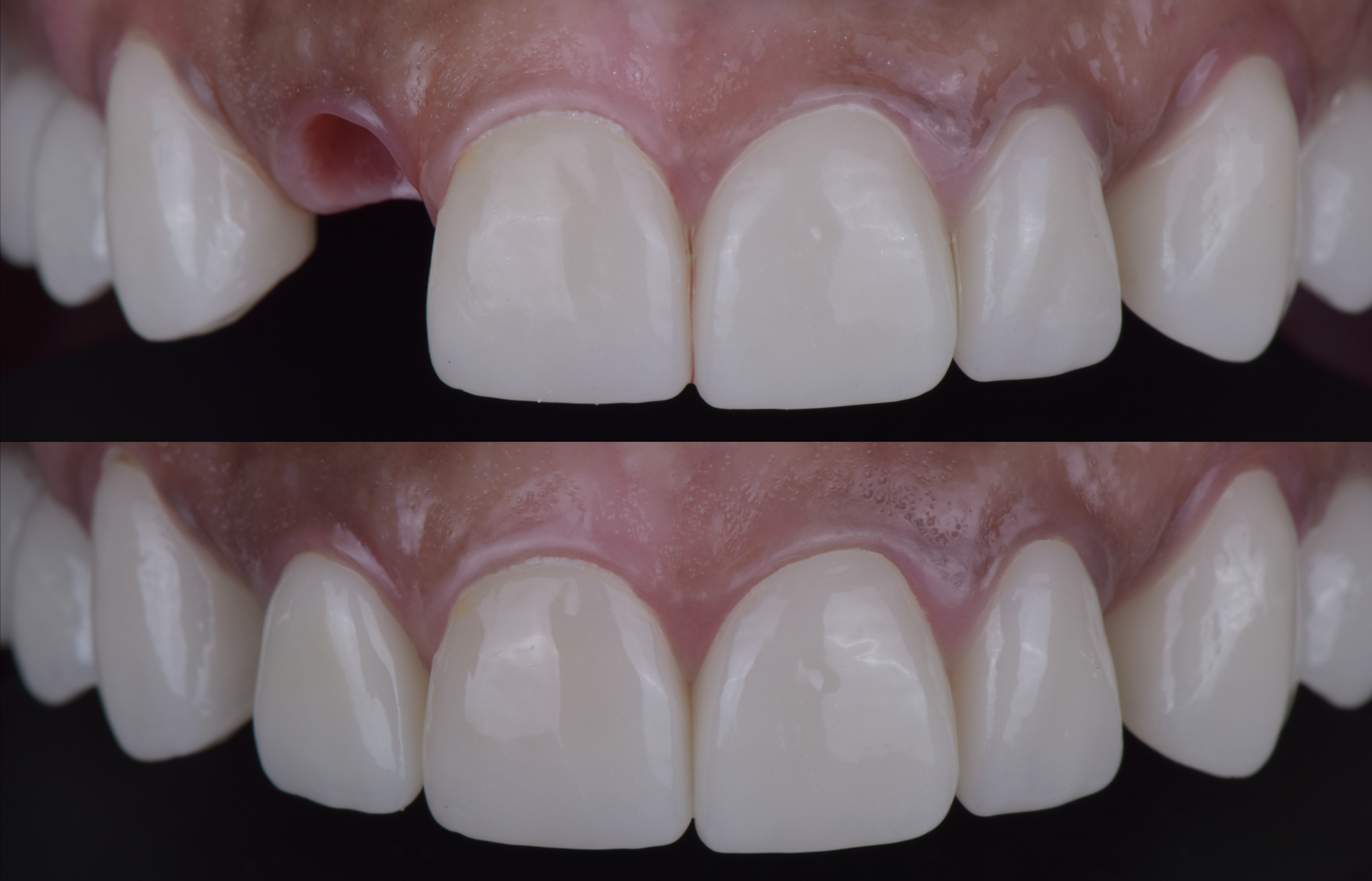 Before and after: front tooth implant with bone and gum grafting at Eden Dental Office Nagoya