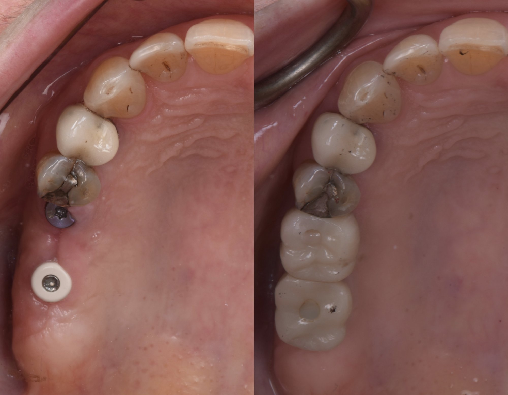 Before and after: single dental implant replacing back tooth at Eden Dental Office Nagoya