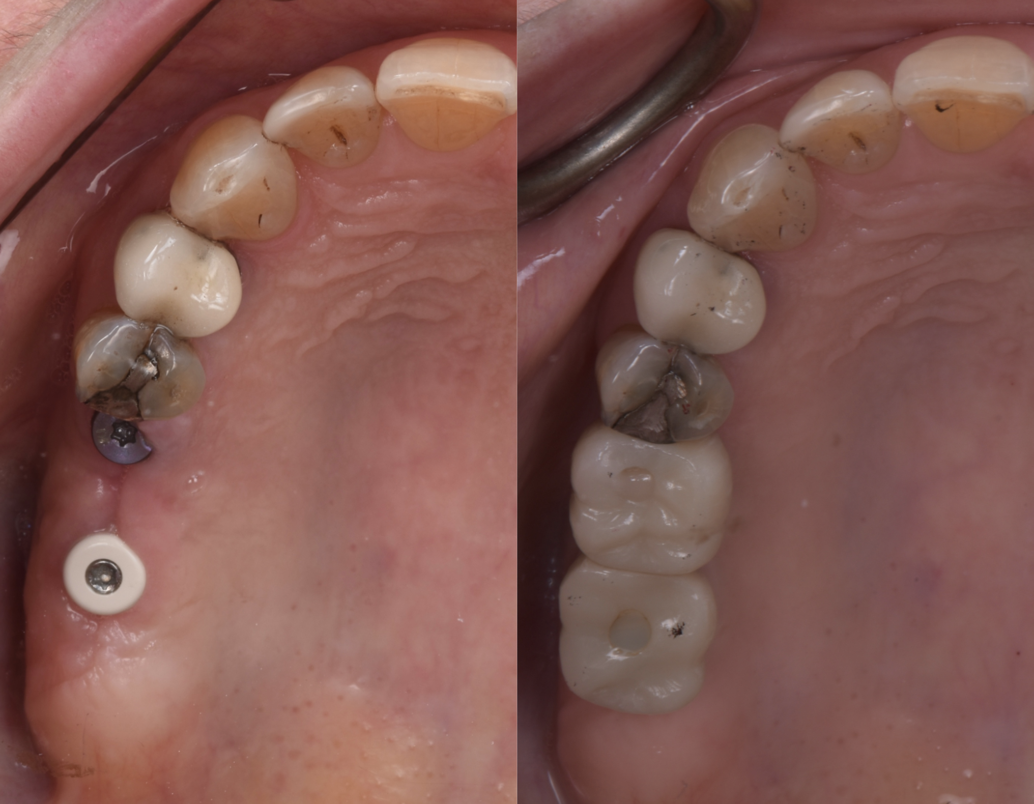 Before and after: single dental implant replacing back tooth at Eden Dental Office Nagoya