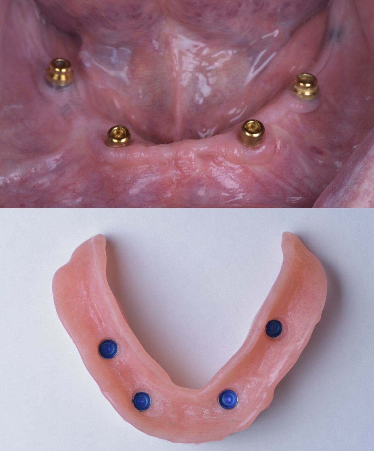 Implant abutments and overdenture for stabilizing loose denture at Eden Dental Office Nagoya