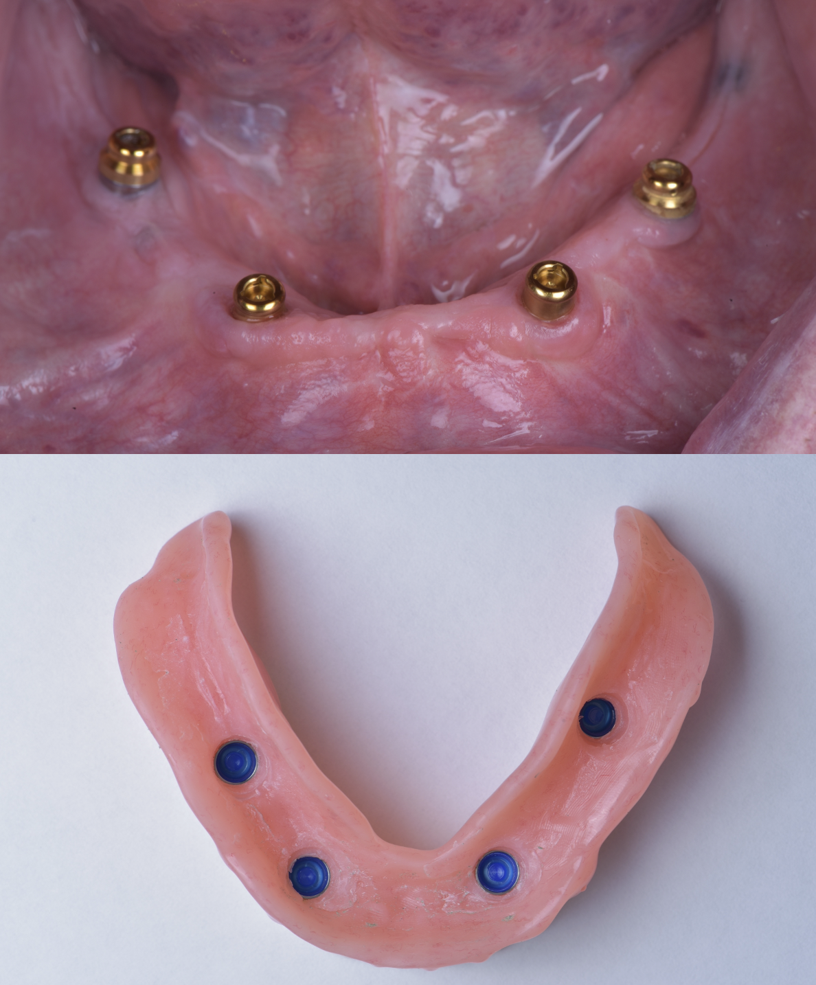 Implant abutments and overdenture for stabilizing loose denture at Eden Dental Office Nagoya