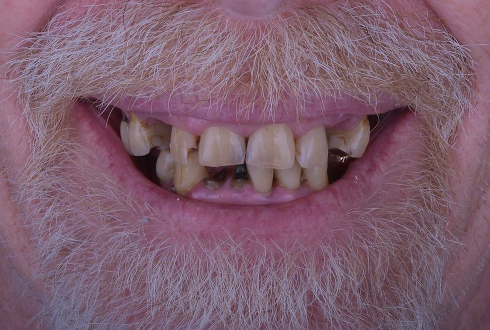 Before All-on-4 dental implants in Nagoya — severely damaged upper teeth