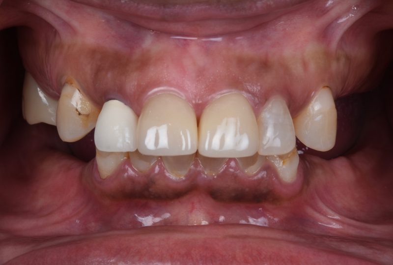 Before porcelain crowns and implant in Nagoya — mismatched old crowns with decay