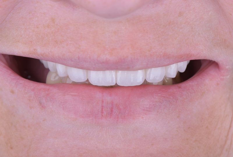 After cosmetic dental restoration in Nagoya — bright, even smile with zirconia crowns at Eden Dental Office