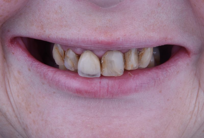 Before cosmetic dental restoration in Nagoya — discolored and uneven front teeth