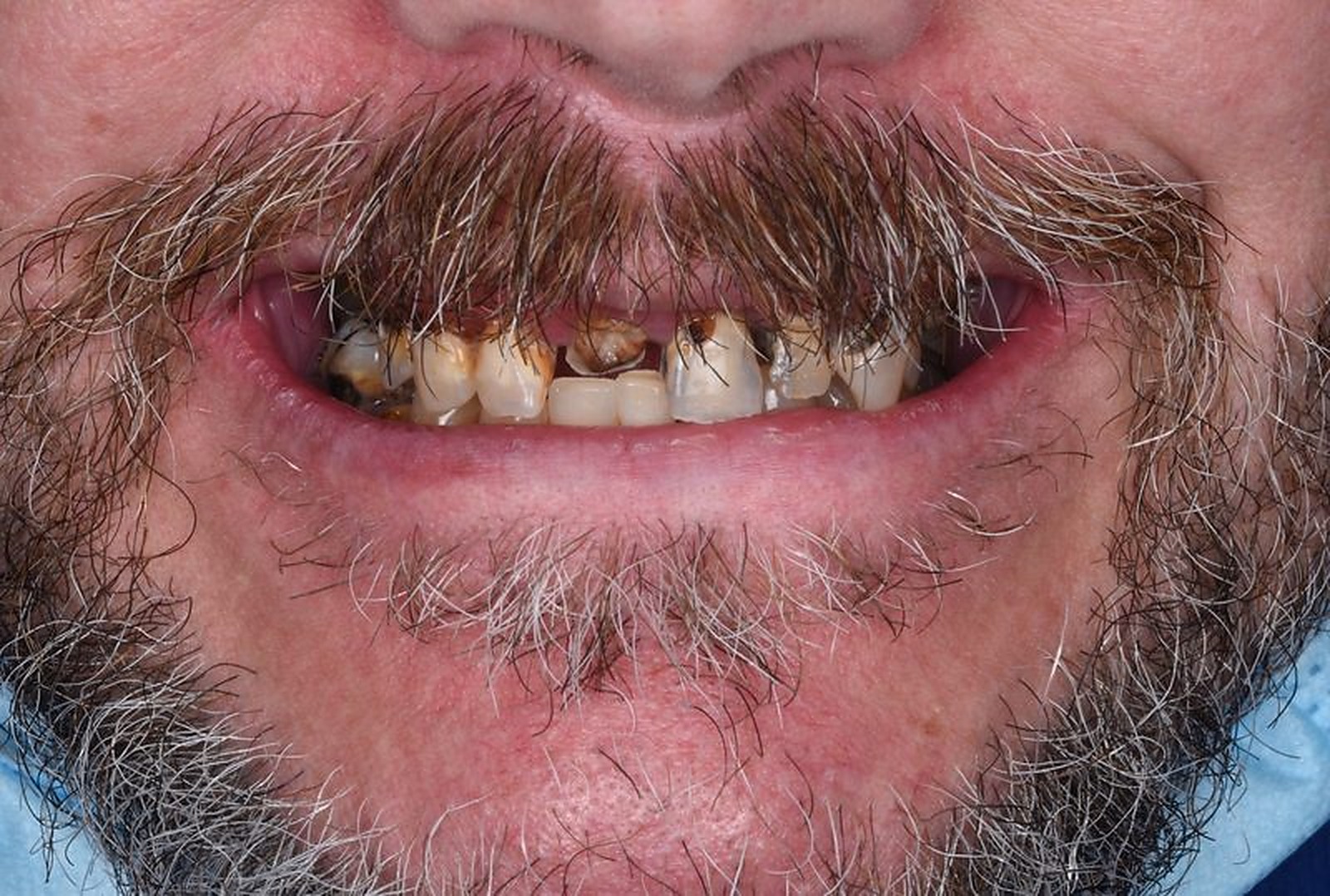 Before All-on-4 implants — worn and decayed teeth, dentist in Nagoya