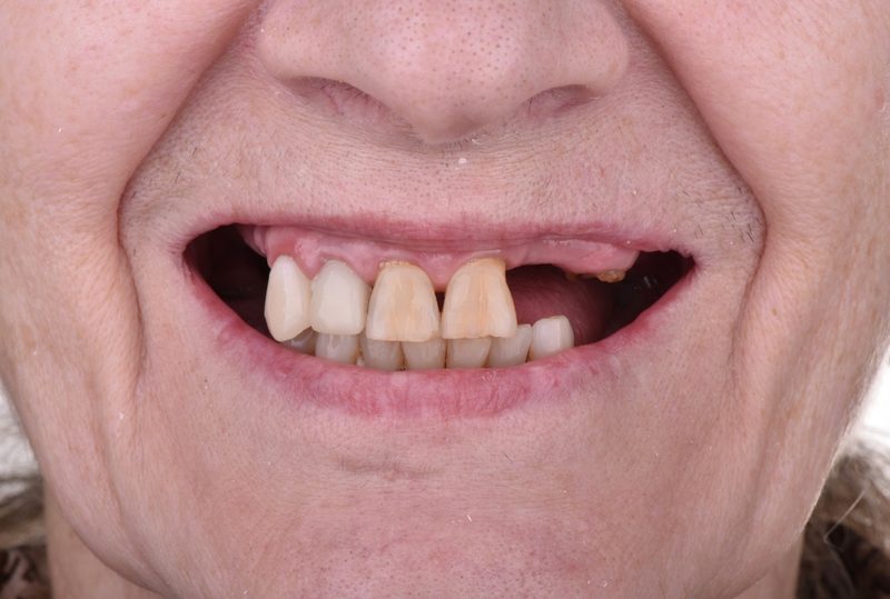 Before full-mouth dental rehabilitation in Nagoya — multiple missing and failing teeth