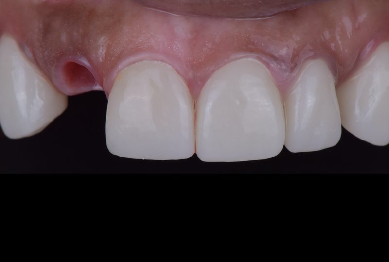 Before single tooth implant in Nagoya — fractured root requiring extraction
