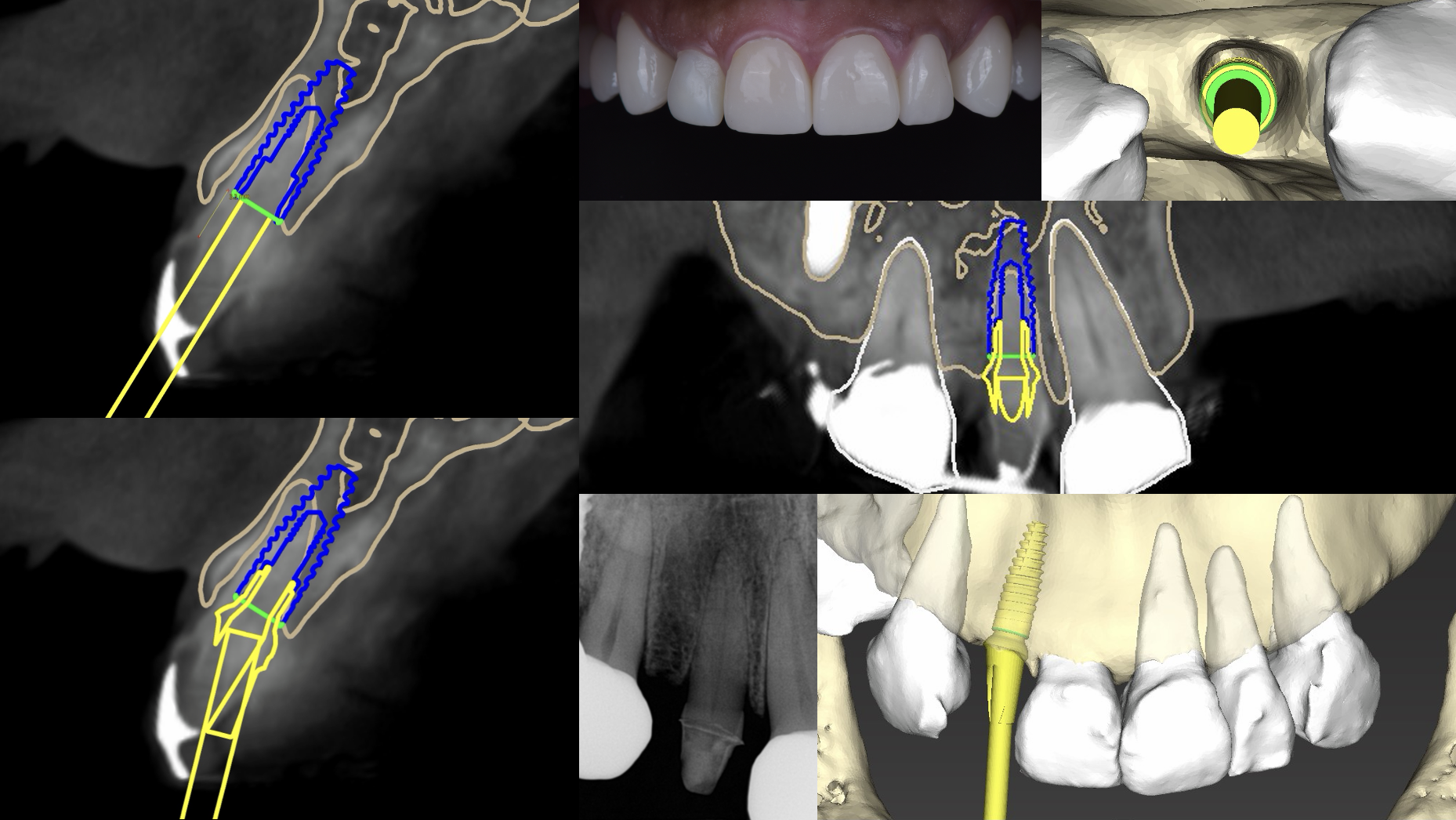 AI-assisted implant simulation at Eden Dental Office