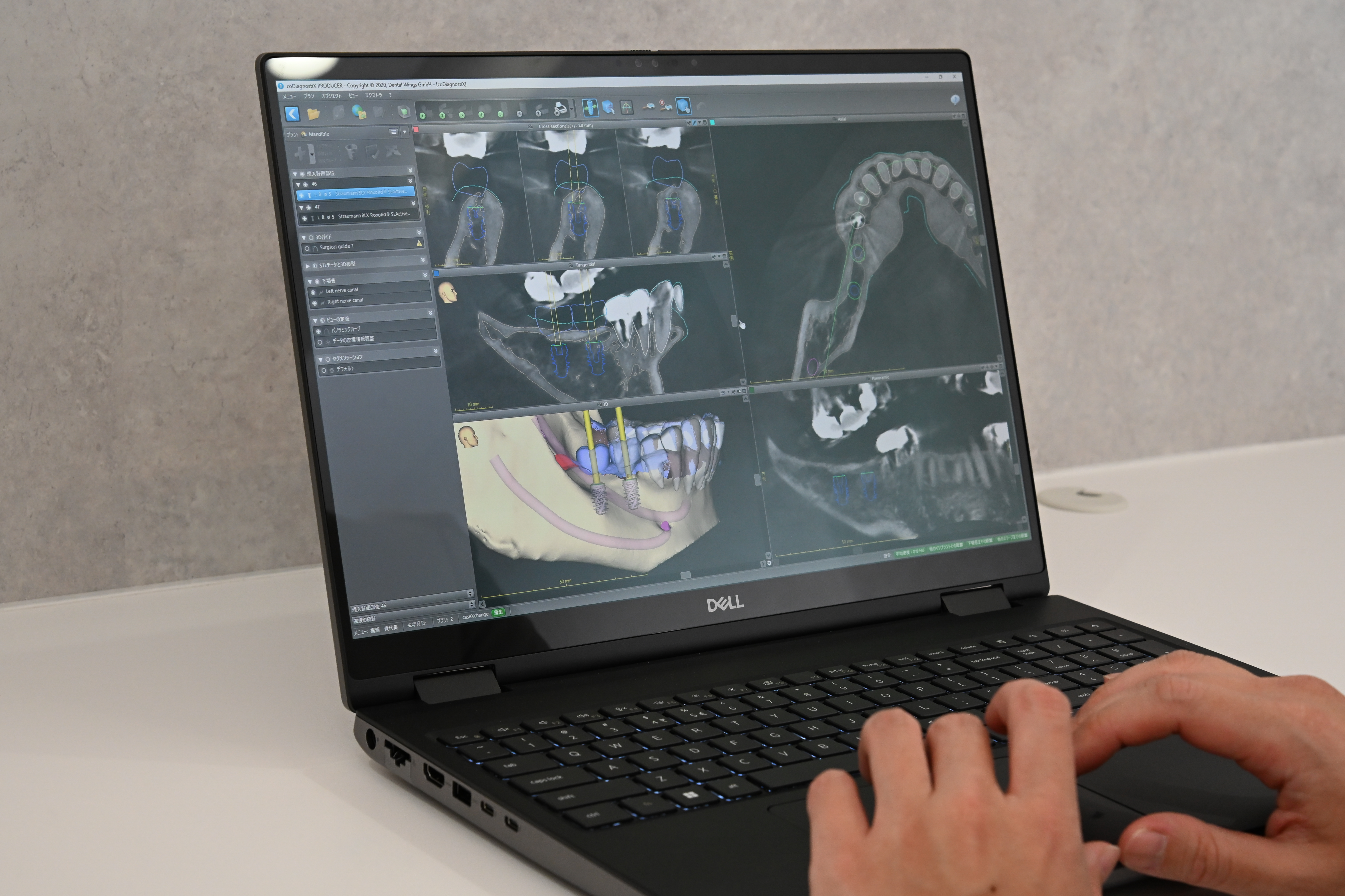 CT simulation and guided implant planning on computer at Eden Dental Office
