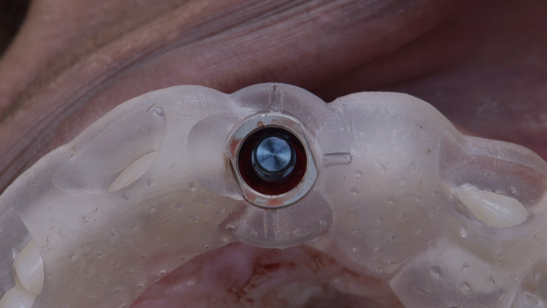 3D-printed surgical guide seated in the mouth for guided implant surgery | Eden Dental Office Nagoya