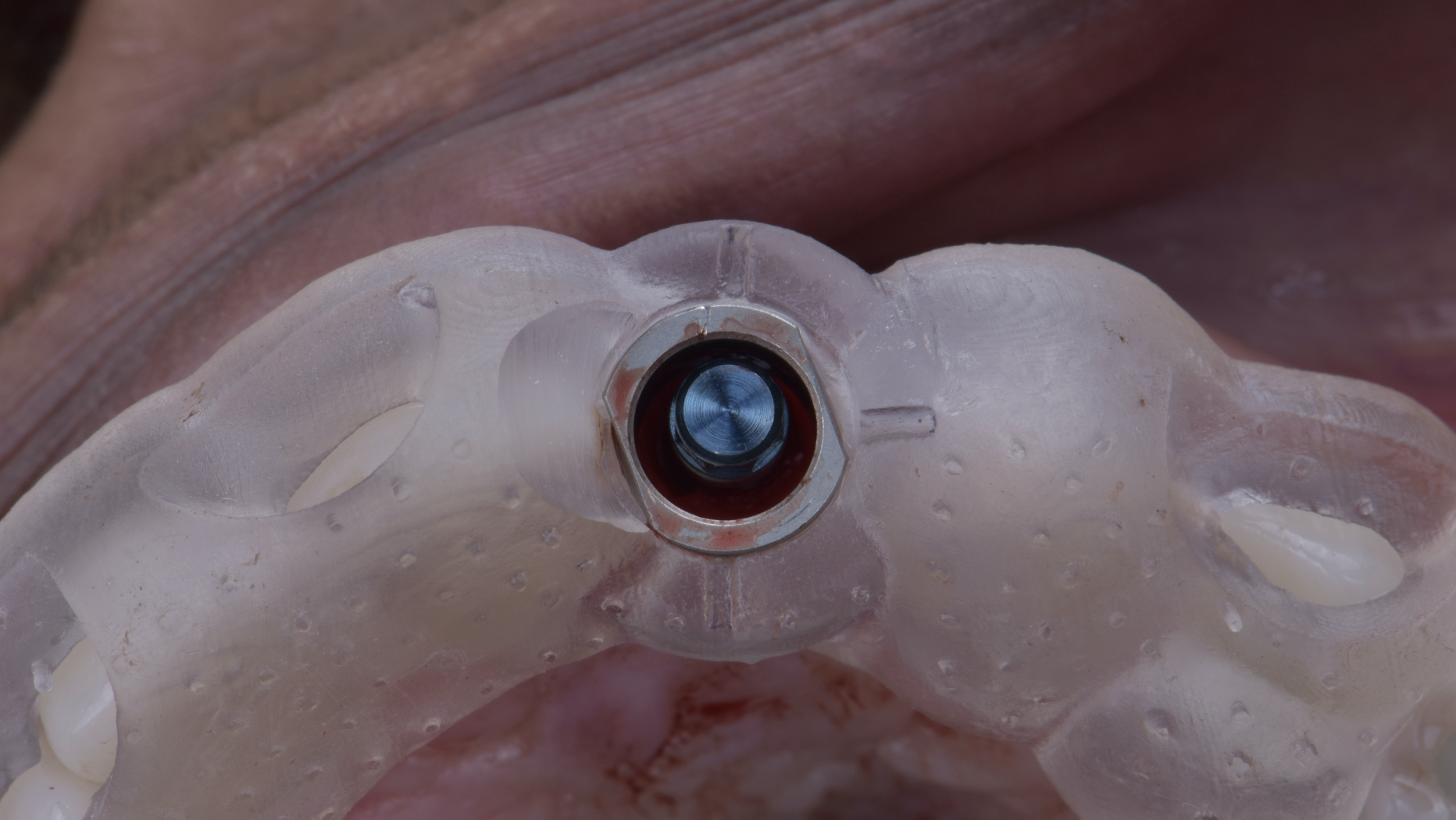 3D-printed surgical guide fitted in patient mouth for guided implant surgery