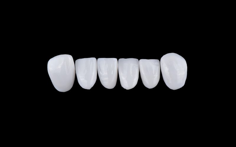 Porcelain crowns crafted for a natural, seamless fit — specialist dentist in Nagoya