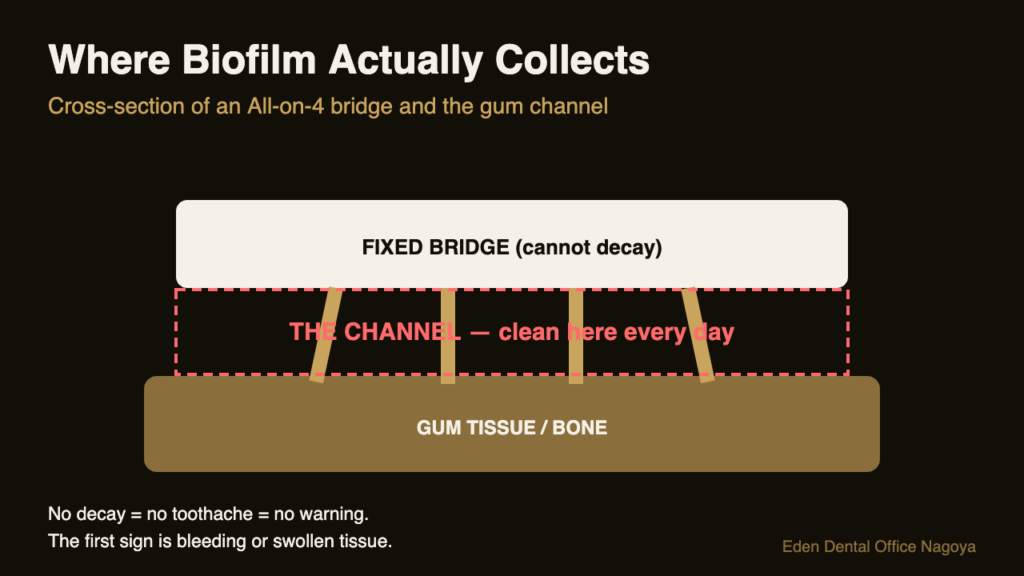 Cross-section diagram showing the channel between an All-on-4 bridge and gum tissue where biofilm collects | Eden Dental Office Nagoya