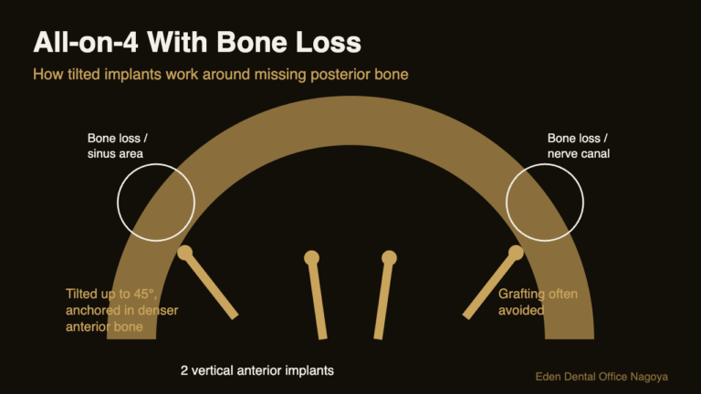 All-on-4 Candidacy in Japan: Bone Loss, Health & Age Factors