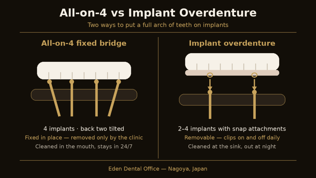 Diagram comparing a fixed All-on-4 bridge with a removable implant overdenture | Eden Dental Office Nagoya