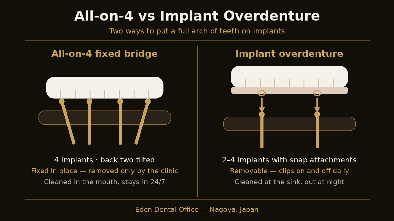 Diagram comparing a fixed All-on-4 bridge with a removable implant overdenture | Eden Dental Office Nagoya