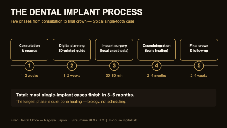 Five phases of the dental implant process timeline diagram | Eden Dental Office Nagoya