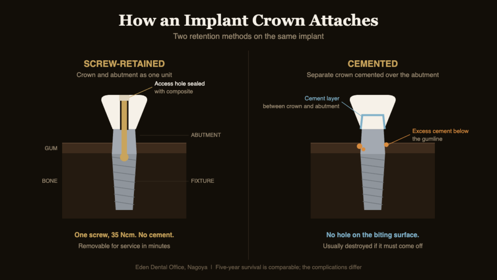 Cross-section comparing a screw-retained implant crown with a cemented implant crown and its subgingival cement margin | Eden Dental Office Nagoya