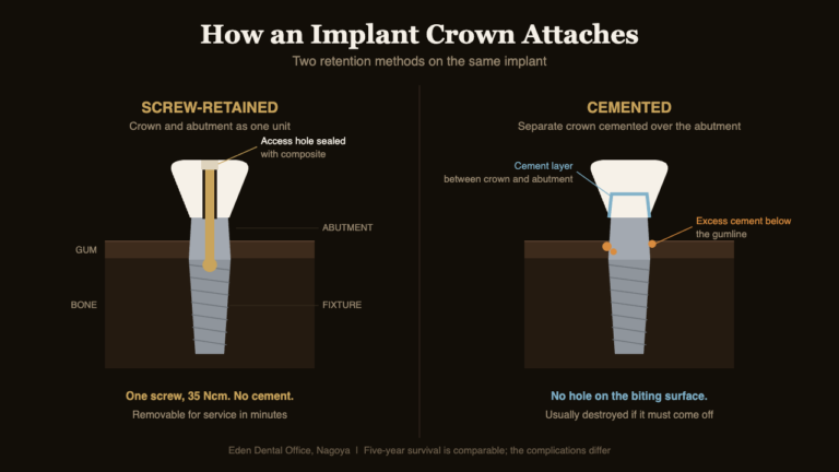 Cross-section comparing a screw-retained implant crown with a cemented implant crown and its subgingival cement margin | Eden Dental Office Nagoya
