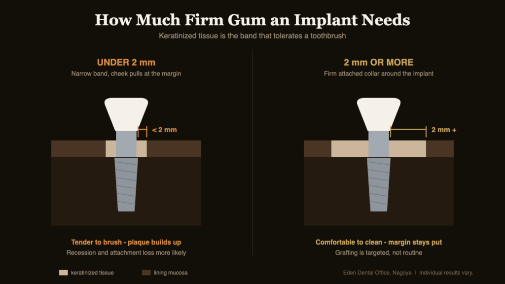 Cross-section comparing under 2 mm and 2 mm or more of keratinized tissue around a dental implant | Eden Dental Office Nagoya