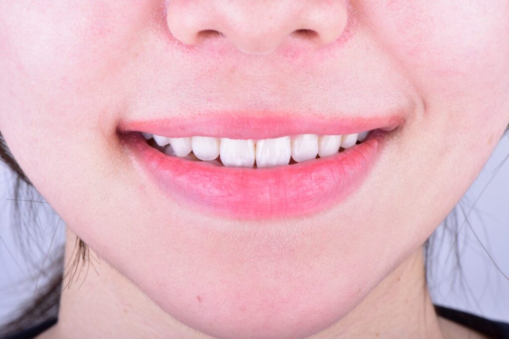 Close-up of an adult smile with restored front teeth | Eden Dental Office Nagoya