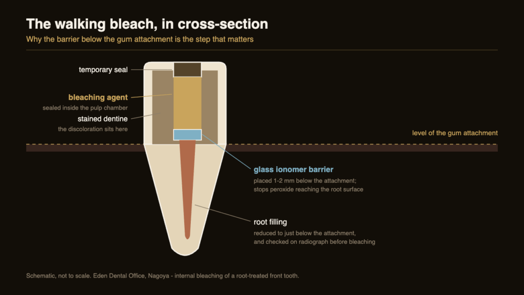 Cross-section of a root-treated front tooth during internal bleaching, showing the glass ionomer barrier placed below the gum attachment | Eden Dental Office Nagoya